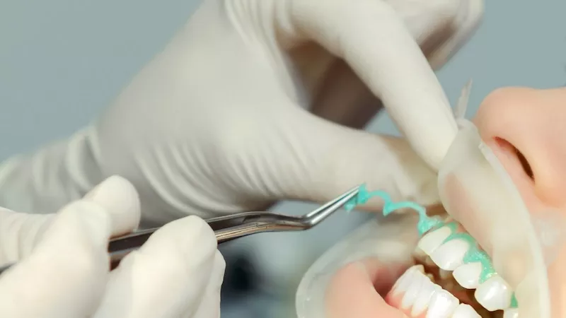 How Exactly Do Teeth Whiteners Work. teeth whitening while breastfeeding